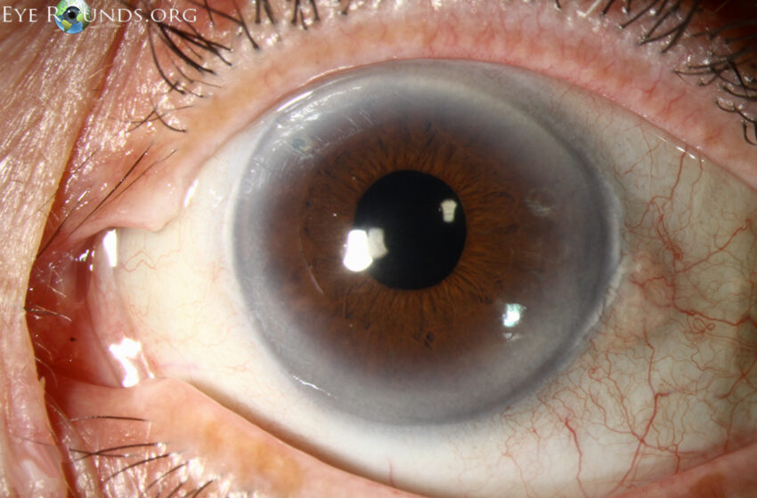  ശരീരത്തിലെ ‘സൈലന്റ് കില്ലർ’; പ്രമേഹവും കൊളസ്ട്രോളും കണ്ണിനെ ബാധിക്കുന്നതെങ്ങനെ?