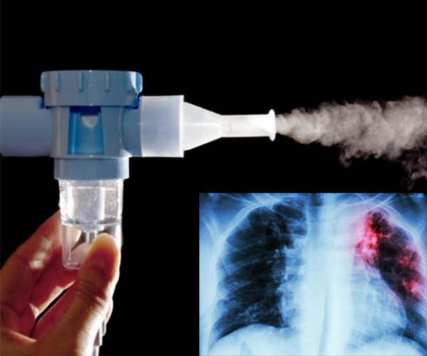  ക്ഷയരോഗ ചികിത്സയിൽ വിപ്ലവകരമായ മാറ്റം: മരുന്നുകൾ ഇനി നേരിട്ട് ശ്വാസകോശത്തിലേക്ക് എത്തിക്കാം